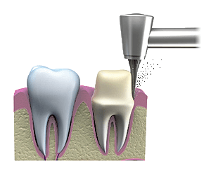 Tooth being filed away to fit a dental crown