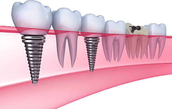 dental patient smiling